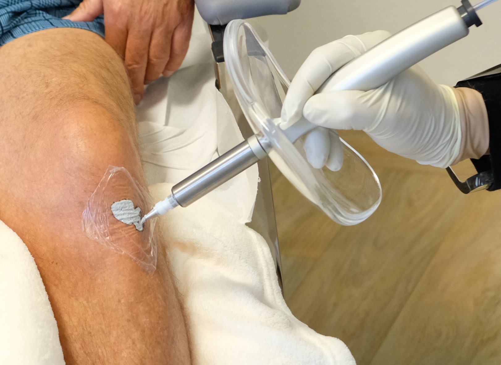 Rhenium-SCT Personalised Treatment On Knee