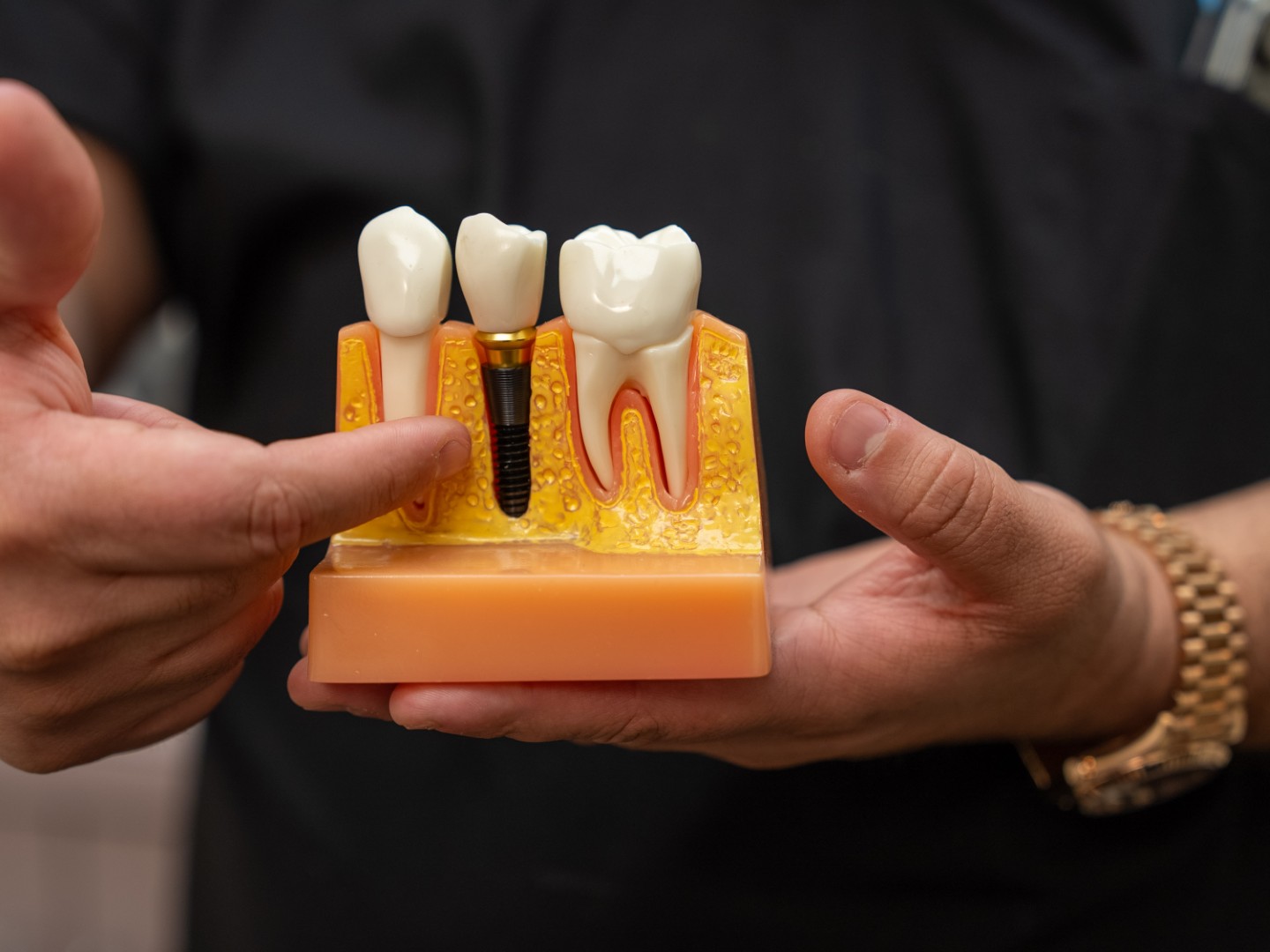 Single Dental Implant Model